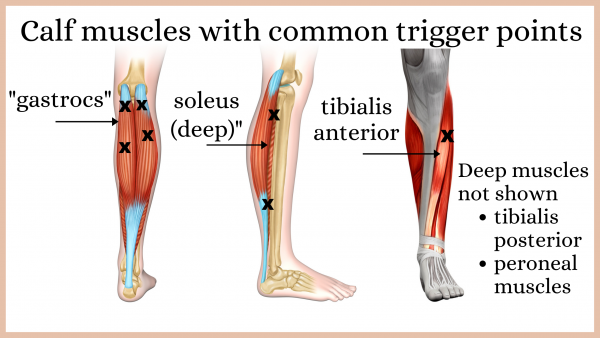 Calf muscles with common trigger points