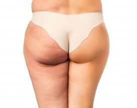 Cellulite before and after 2