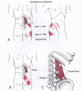 Quadratus Lumborum muscle with trigger points