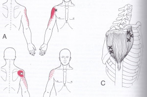 Deltoid muscles, trigger points and pain referral