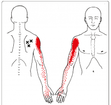 Infraspinatus muscle trigger points and pain referral