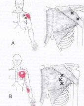 Pectoralis Major Muscle, trigger points and pain referral