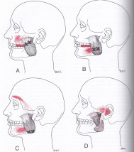 Masseter muscle trigger points