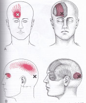 Occipitalis and frontalis muscle trigger points
