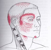 Sternocleidomastoid muscle trigger points