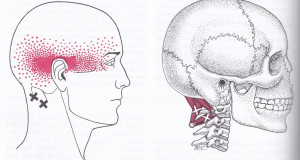Sub occipital muscle trigger points