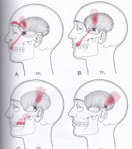 Temporalis muscle trigger points