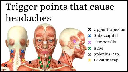Diagram of trigger points causing headaches