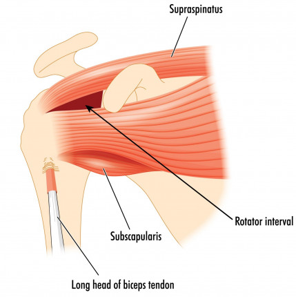 Supraspinatus and subscapularis muscles