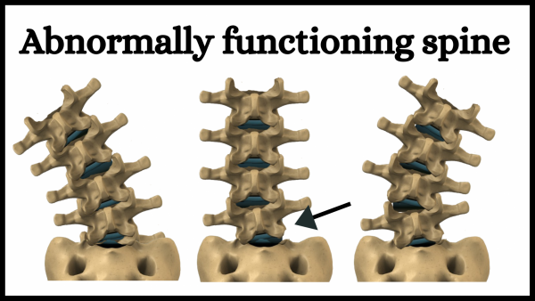 Abnormally functioning spine