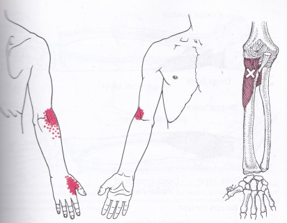 Trigger points in supinator muscle