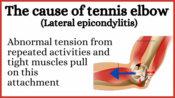 Tennis elbow with cause