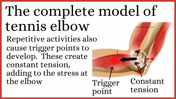 The complete model of tennis elbow