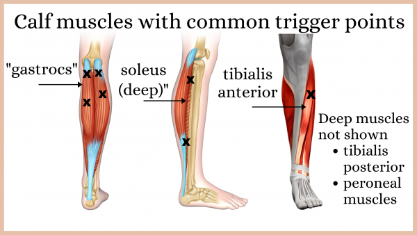 Massage and trigger point therapy for calf pain, with self help options   Massage and trigger point therapy for calf pain, with self help options