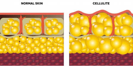Cellulite and normal skin