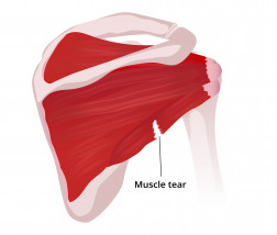 Muscle tear