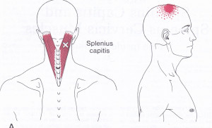 Splenius Capitus Muscle with trigger points and pain referral