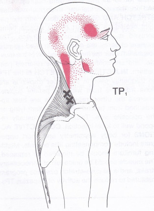 Upper trapezius muscle with common points and pain referral