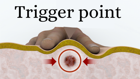 (Myofascial) trigger point