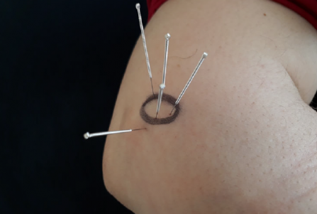 Acupuncture for tennis elbow