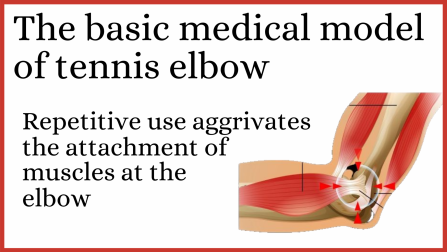 The medical model of tennis elbow