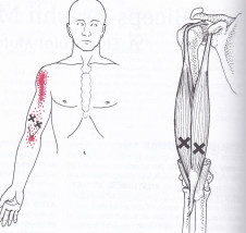 Biceps muscle, trigger points and pain referral