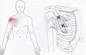 Pectoralis Minor Muscle, trigger points and pain referral