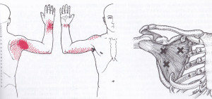 Sub scapularis Muscle, trigger points and pain referral