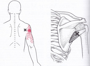 Teres minor muscle, points and pain