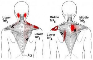 Trapezius muscle, trigger points and pain