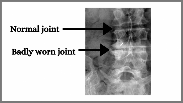 X-ray of spine with degenerative changes
