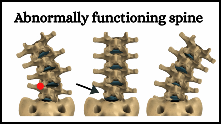 Abnormally functioning spine