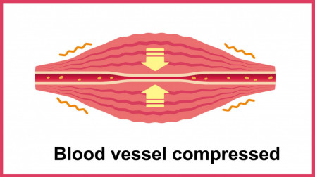 Tightened muscles press on blood vessels
