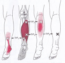 Example of trigger point diagram