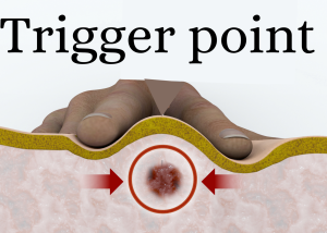Trigger point