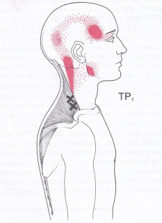 Upper trapezius muscle knots (trigger points)
