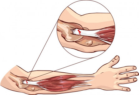 Tennis elbow diagram